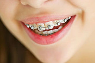 wire-orthodontics