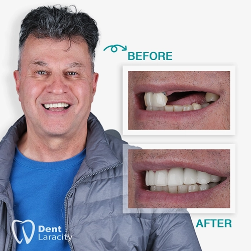 Before & after Dental Implant & Veneer Before & after Dental Implant