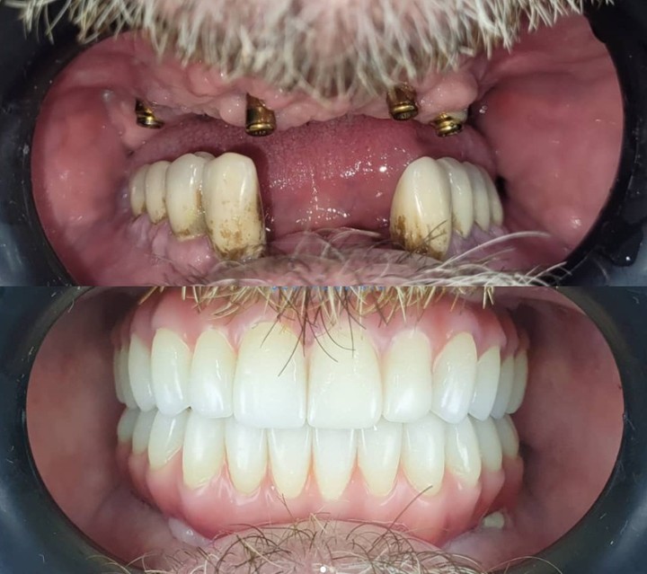 Before & after All On 4 Implant-2