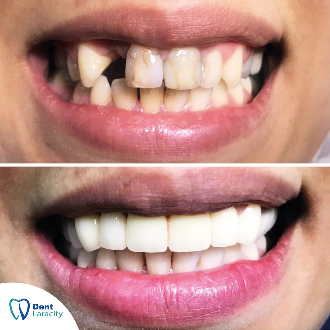 Before & after Dental Implant