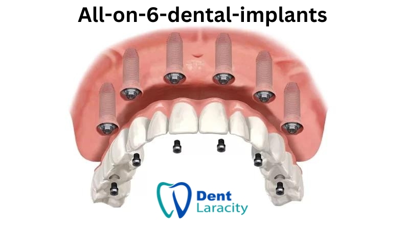 All on 6 dental implants Turkey