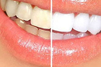 Teeth Whitening (Bleaching)