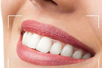 Digital Smile Design (Hollywood Smile)