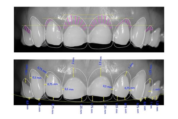 Antalya Digital Smile Design