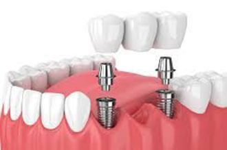 Implant Treatments